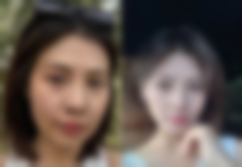 埋线双眼皮取线后修复时间大揭秘