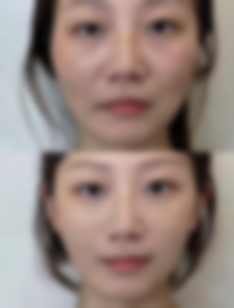 不同抽脂方式大比拼：安心与否如何抉择