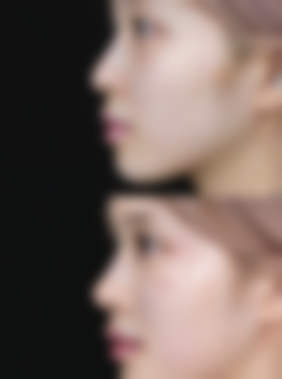 割了双眼皮有没有后遗症？感染、疤痕增生、双眼不对称这些风险要警惕！