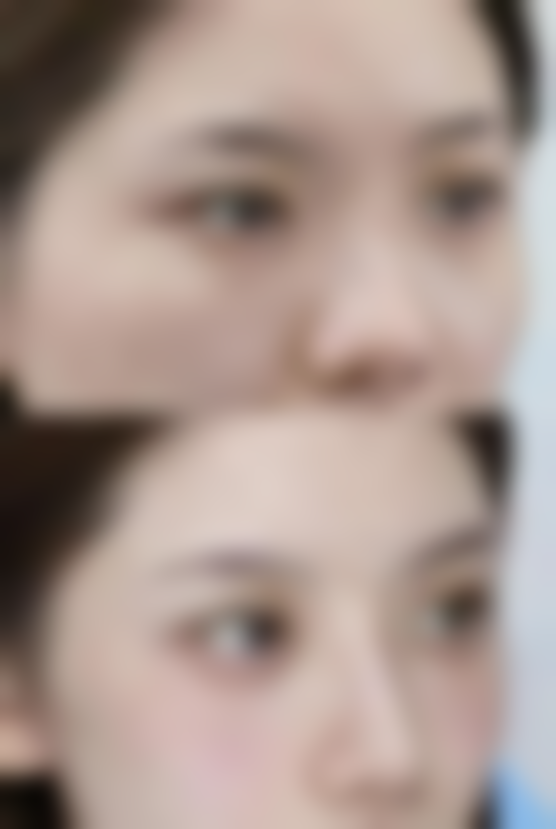 割了双眼皮有没有后遗症之眼部干涩困扰