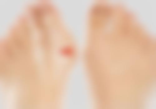 割双眼皮有痕迹修复之风险把控