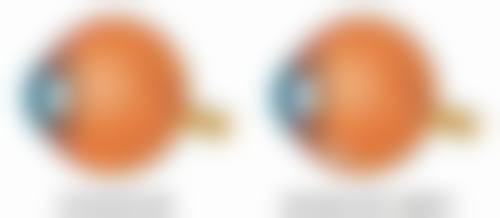 有没有快速去眼袋的产品?急救消肿小妙招!