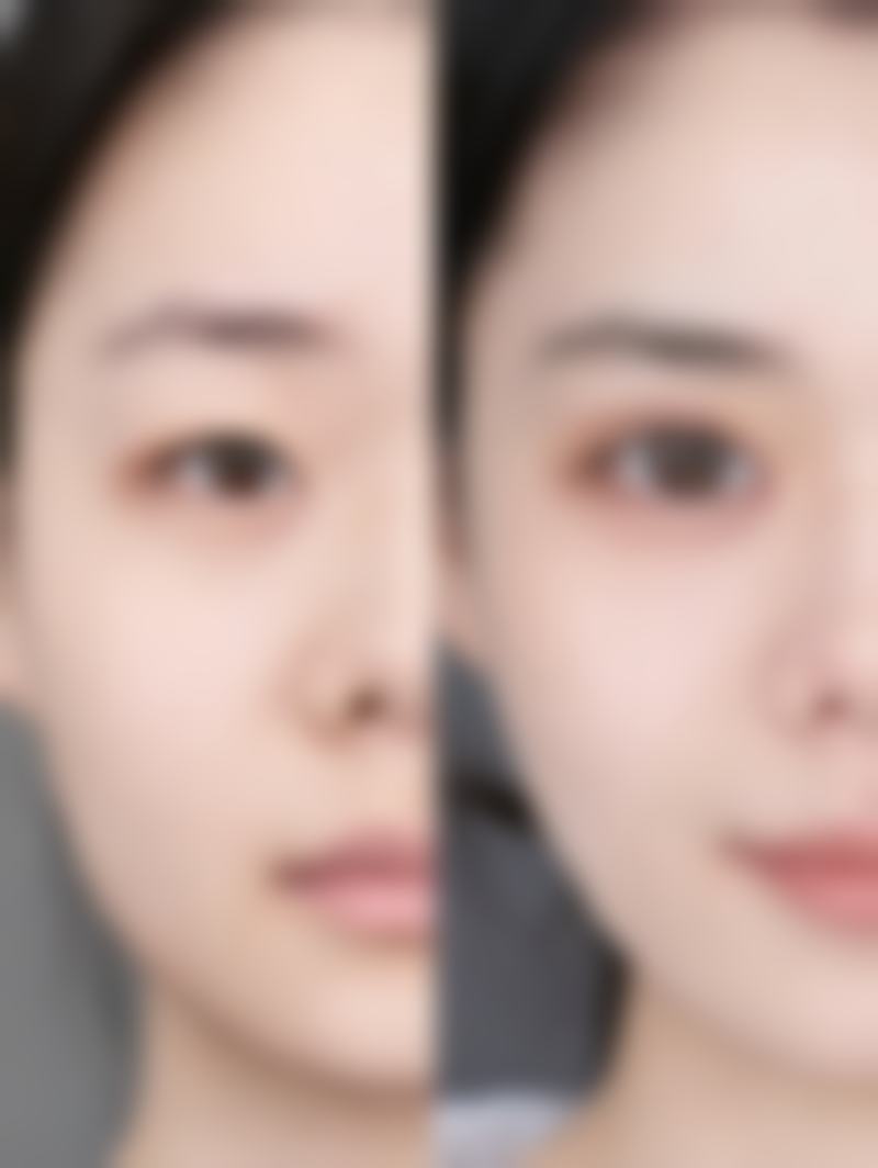 隆胸后取出胸部下垂问题：一定会下垂吗？如何巧妙预防？