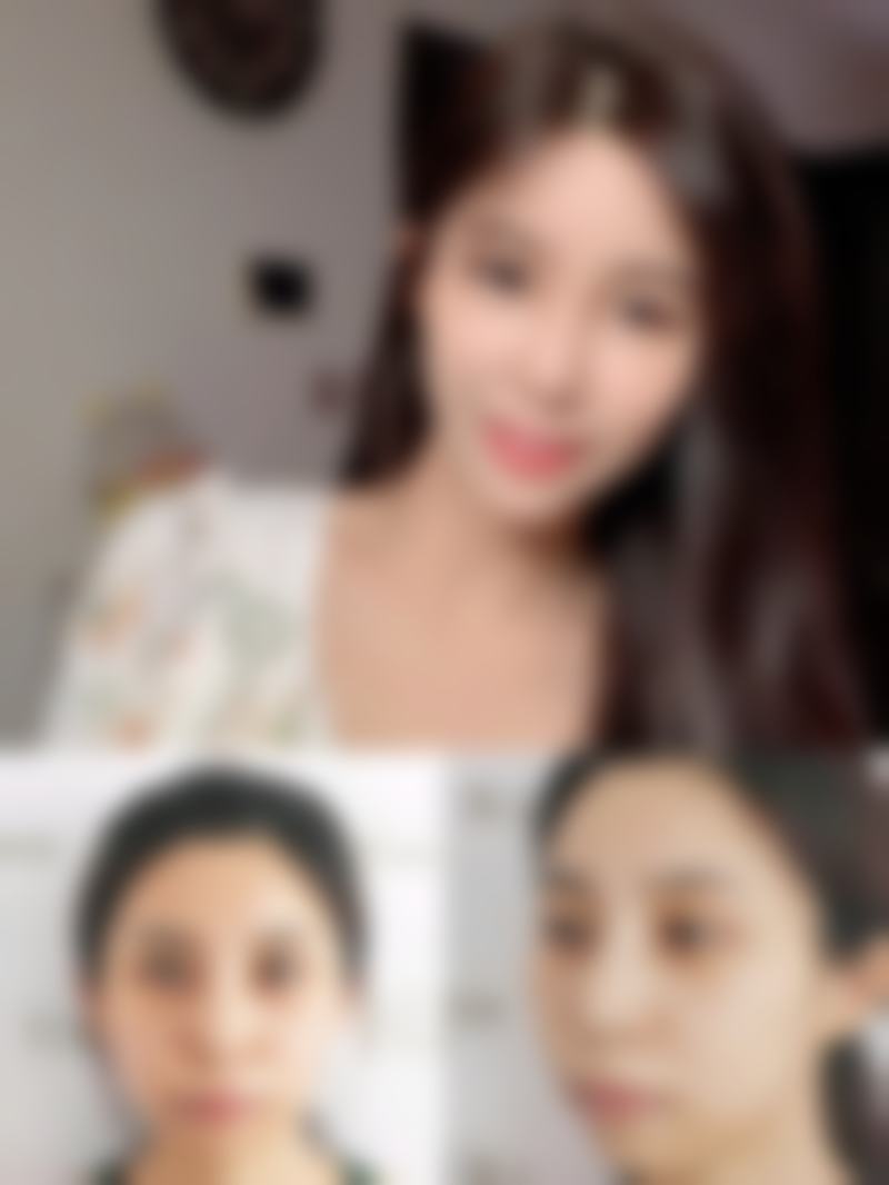 外切眼袋手术多久可以消肿