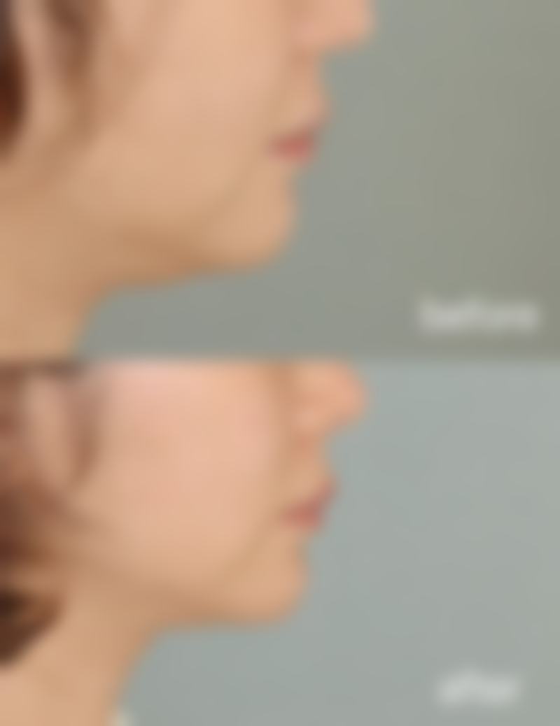 如何更有效的去眼袋，医美激光+穴位按摩双管齐下告别泡泡眼