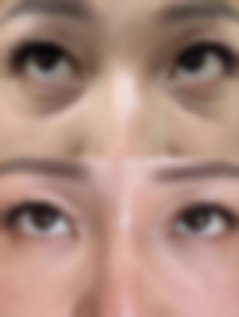 自体脂肪隆胸多久可以第二次？3-6个月后二次手术更安全，脂肪存活率更高！