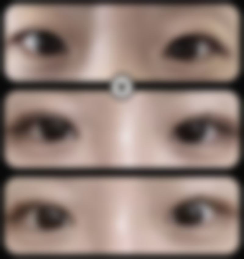 【眼部整形+8000】武汉斯启诺医疗美容门诊部的眼部整形是否划算