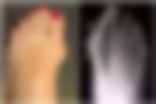 为什么疤痕愈合后会痒:组织胺——瘙痒的幕后“黑手”