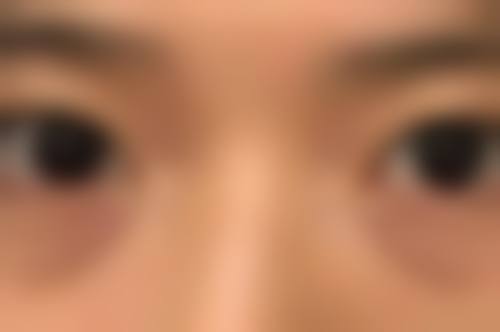 为什么疤痕愈合后会痒，手术烫伤疤痕为何越挠越痒？