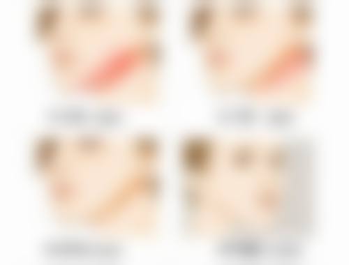 20年前埋线双眼皮拆线时疼痛程度解析