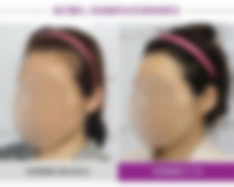 医美VS居家：眼袋消除方案全对比