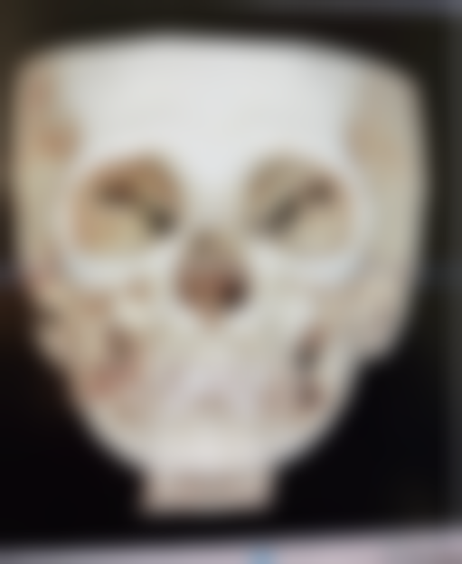 熬夜如何全方面“破坏”疤痕体质者的疤痕修复