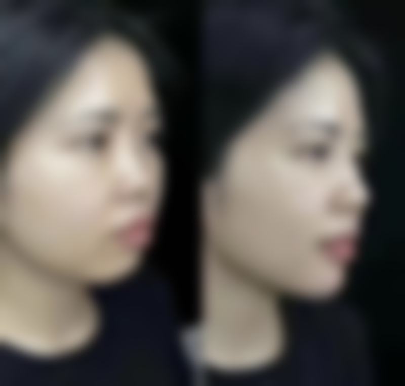 腿部抽脂医院选择与脂肪栓塞危害