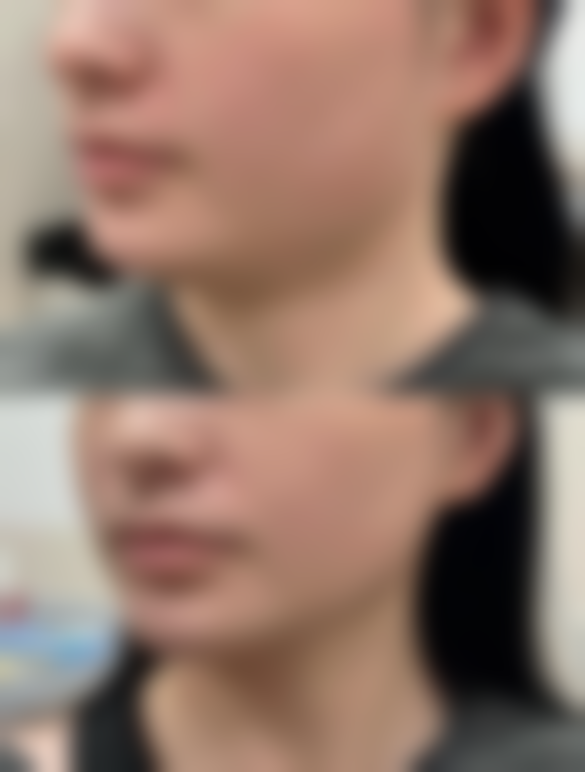 疤痕体质熬夜:疤痕增生风险飙升的背后真相