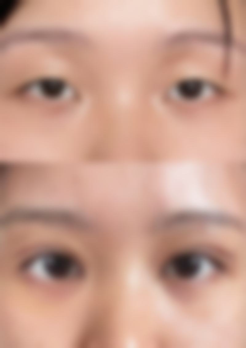 怎样去除儿童脸部烫伤疤痕：专属小天使脸蛋的修复魔法