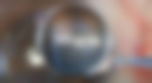 正规医院大腿吸脂以后多久消肿