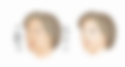 成都美容整形医院分析儿童期疤痕体质随着年龄显现特征