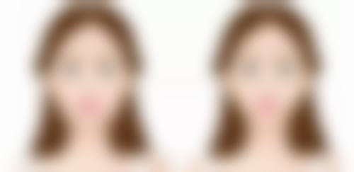 曼托假体做隆胸之成效自然度探究