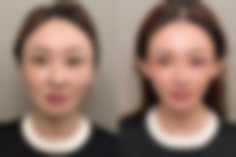 双眼皮变三眼皮之术后护理：精心呵护助力快速修复