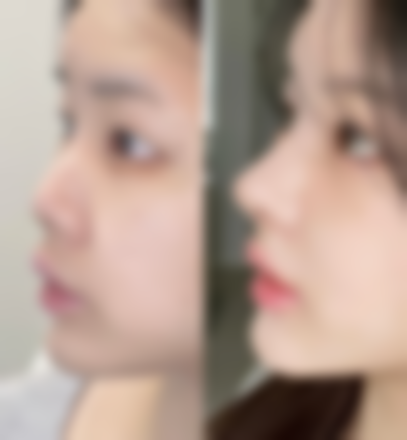 家长必知：儿童疤痕体质随着年龄不会消失但有变化