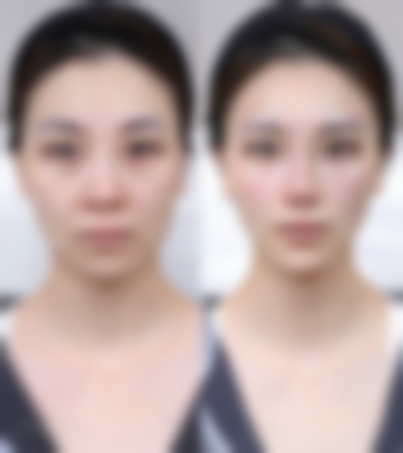 做完双眼皮眼睛和眉毛更近了怎么办：预防胜于治疗——术前设计要点