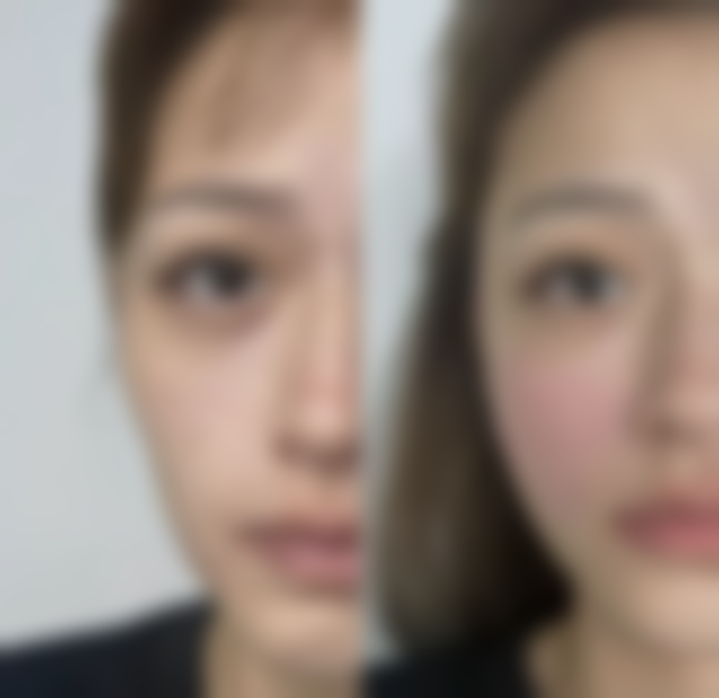 做完双眼皮眼睛和眉毛更近了怎么办：修复期注意事项