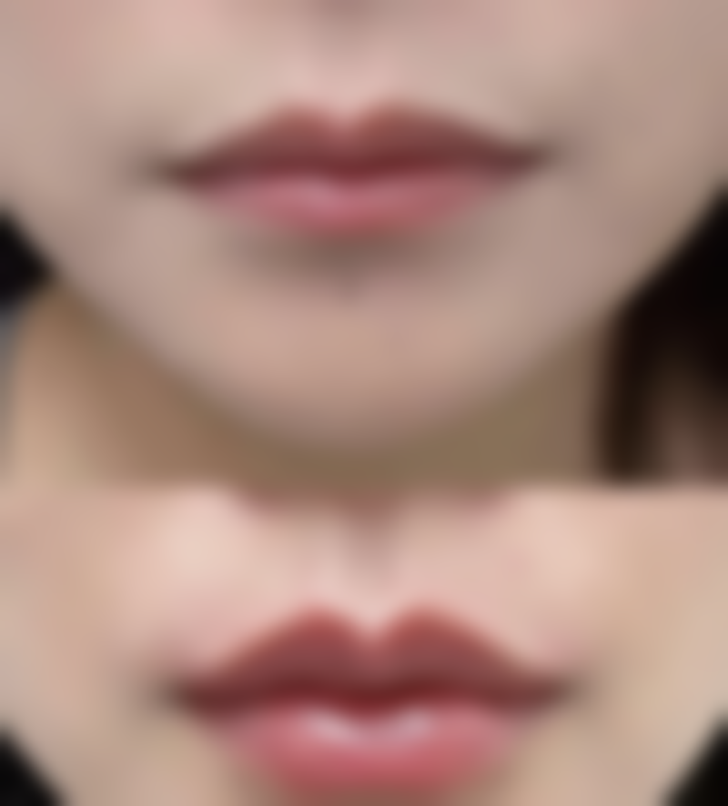 曼托假体做隆胸好吗？效果自然又安全，价格恢复期全解析