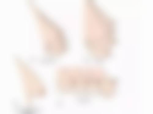 切除眼袋的疤痕多久才能好?手术方式与个人特质的影响