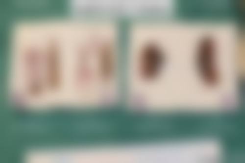 成都密爱天使医疗美容医院【阴道紧缩手术(中度)+14000】顾客实例