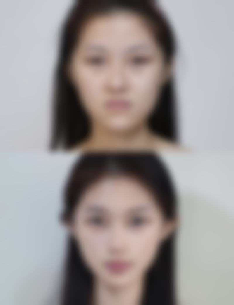 祛痣增生疤痕怎么才能去除？激光+药物双管齐下，中医调理更有效