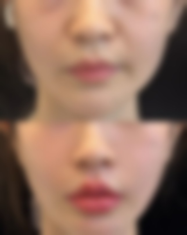 药物去除咬伤疤痕的优质产品推荐