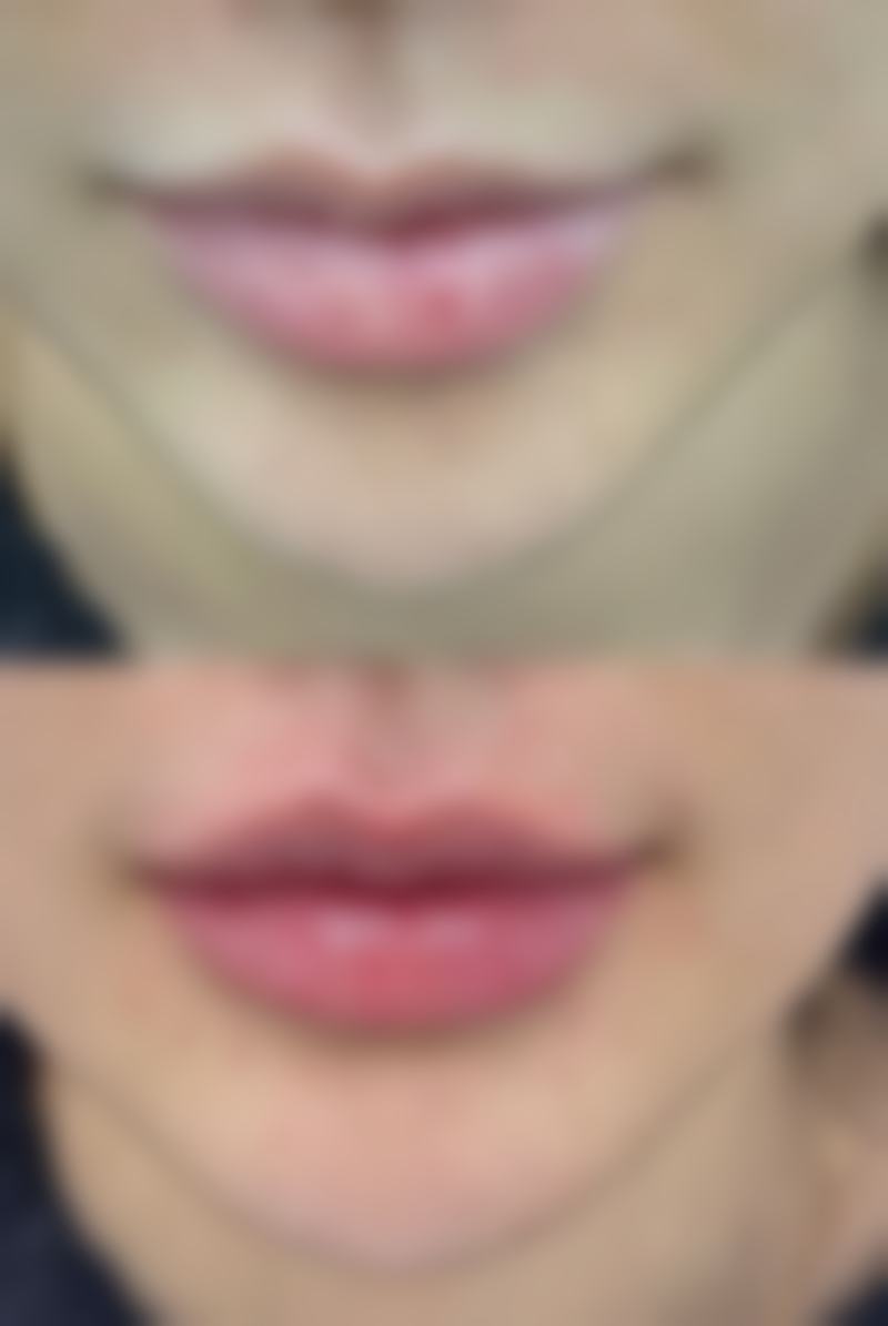 做双眼皮有必要提肌吗之提肌的好处论证