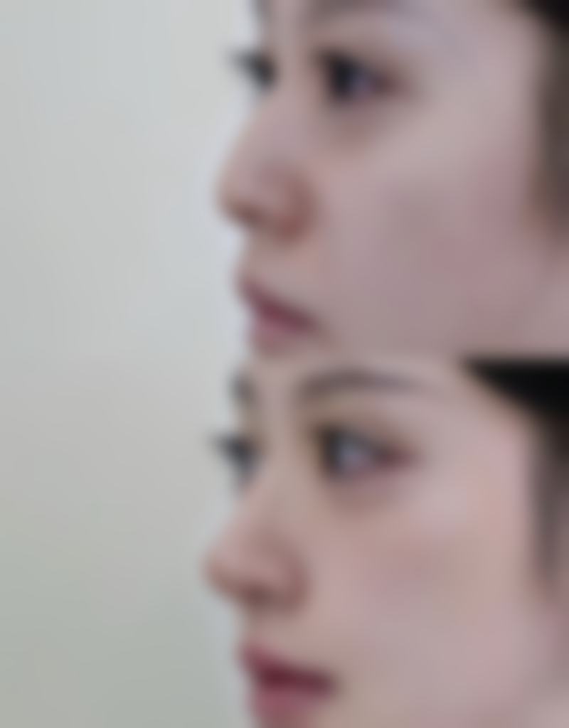 打了瘦脸针多久反弹：饮食红黑榜决定成效时长