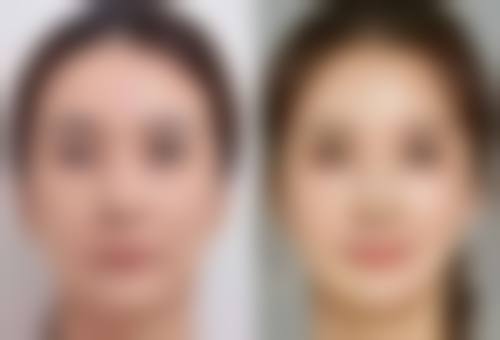 陈春海医生做手术价格