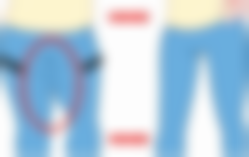 怎么除顽固的眼袋，医美激光+中医按摩双管齐下告别泡泡眼