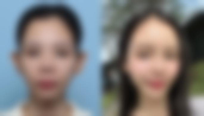 隆鼻的寿命有多长？硅胶10-15年，膨体20年，自体软骨终身可期！