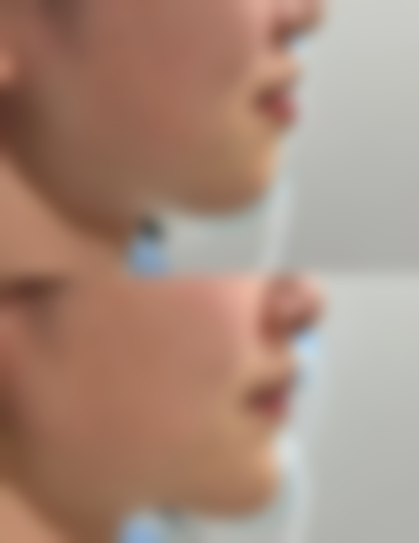 皮肤有疤痕增生的护理方法