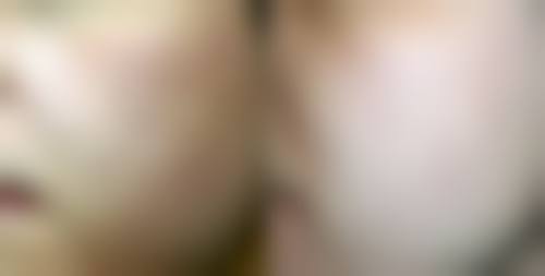 光子嫩肤治疗凸起疤痕有效性探究