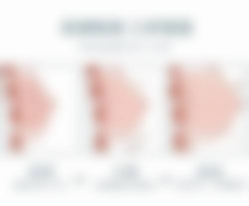 半恒久双眼皮能维持3 - 5年是真的吗