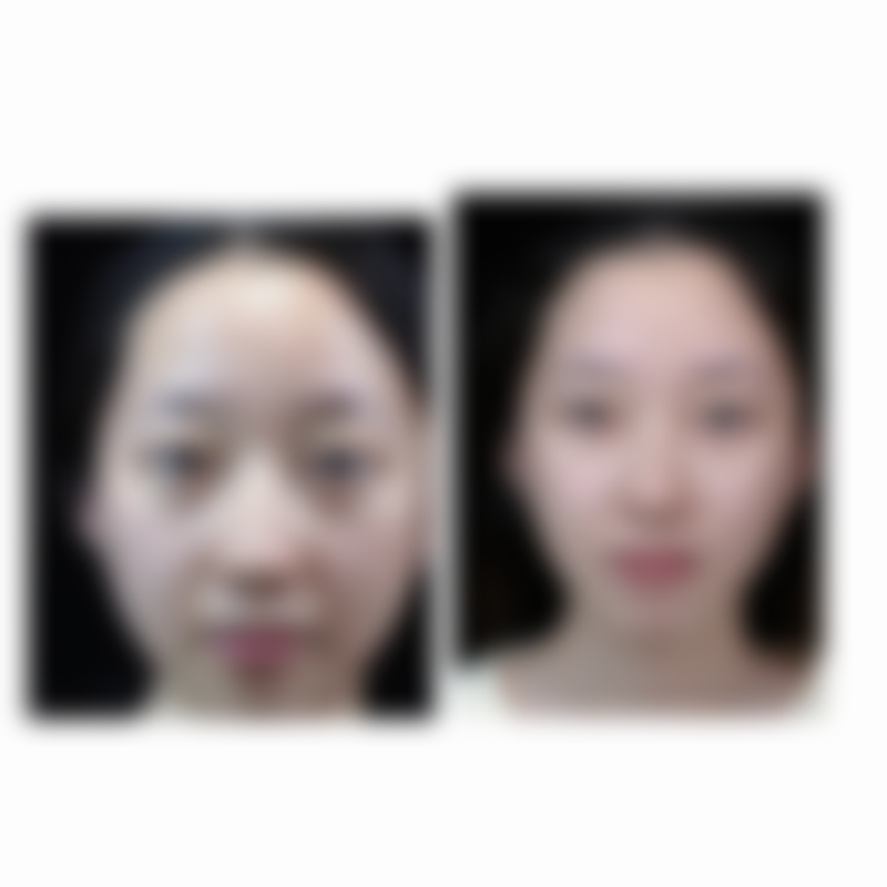 Park双眼皮的操作原理是什么意思