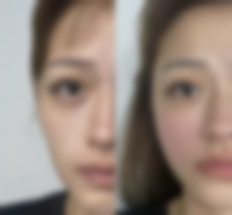 帅楠眼袋贴敏感肌中招概率解析