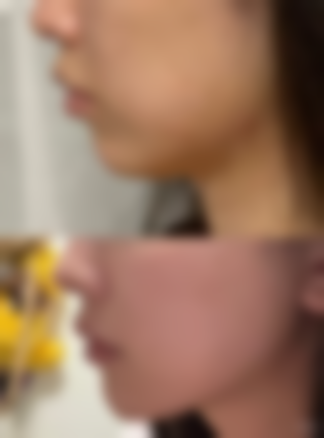 光子嫩肤能治疗哪些类型的疤痕分析