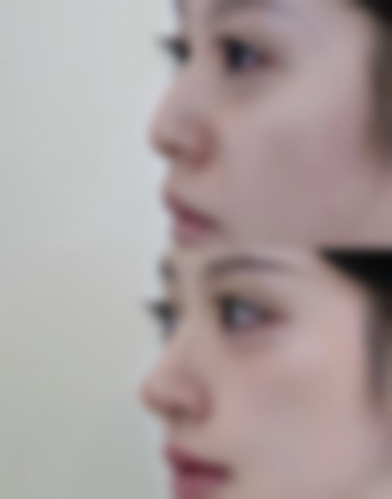 隆鼻鼻头有点歪，医院揭秘矫正费用