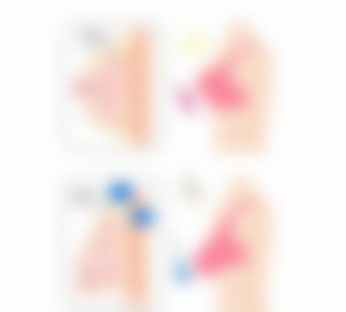 内切与外切眼袋疤痕增生对比