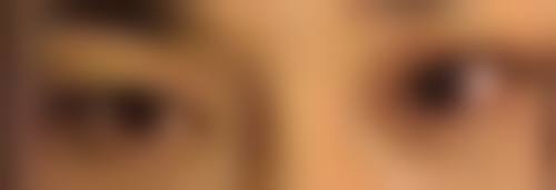 怎样去除增生性疤痕好——手术治疗:医院给出的疤痕“终极解决方案”