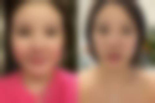 烫伤疤痕十几年了可以修复吗？激光+注射祛疤效果对比，费用1-2万起