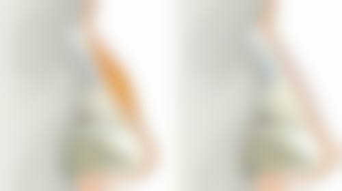 做眼袋手术什么年龄合适——后天形成眼袋篇