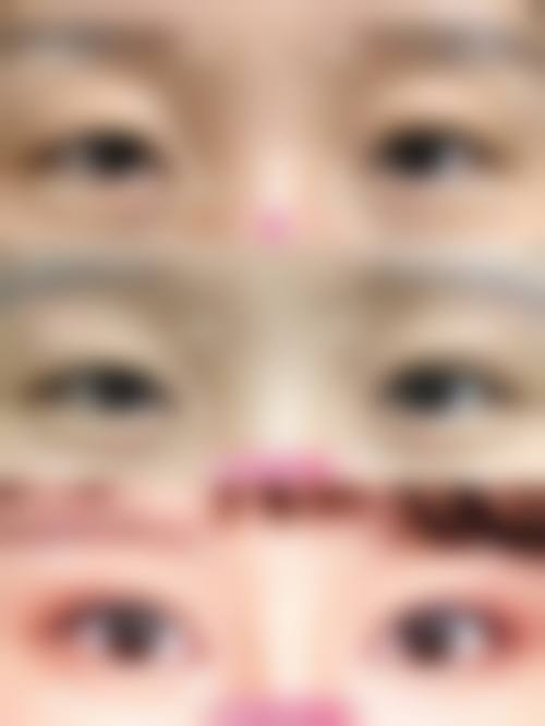 南通英莎医美【全切双眼皮与眼袋外切二选一特别优惠 10000】术后修复与成效呈现