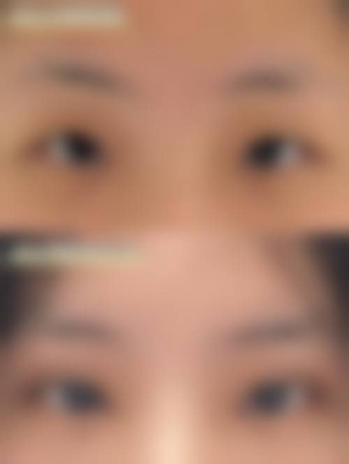 南通英莎医美【全切双眼皮与眼袋外切二选一特别优惠 10000】顾客实例参考