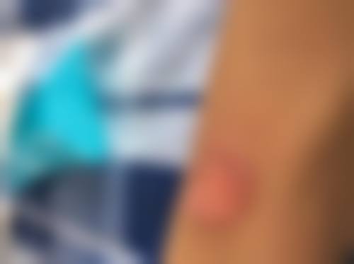 泉州悦美星辰整形外科门诊部顾客实例